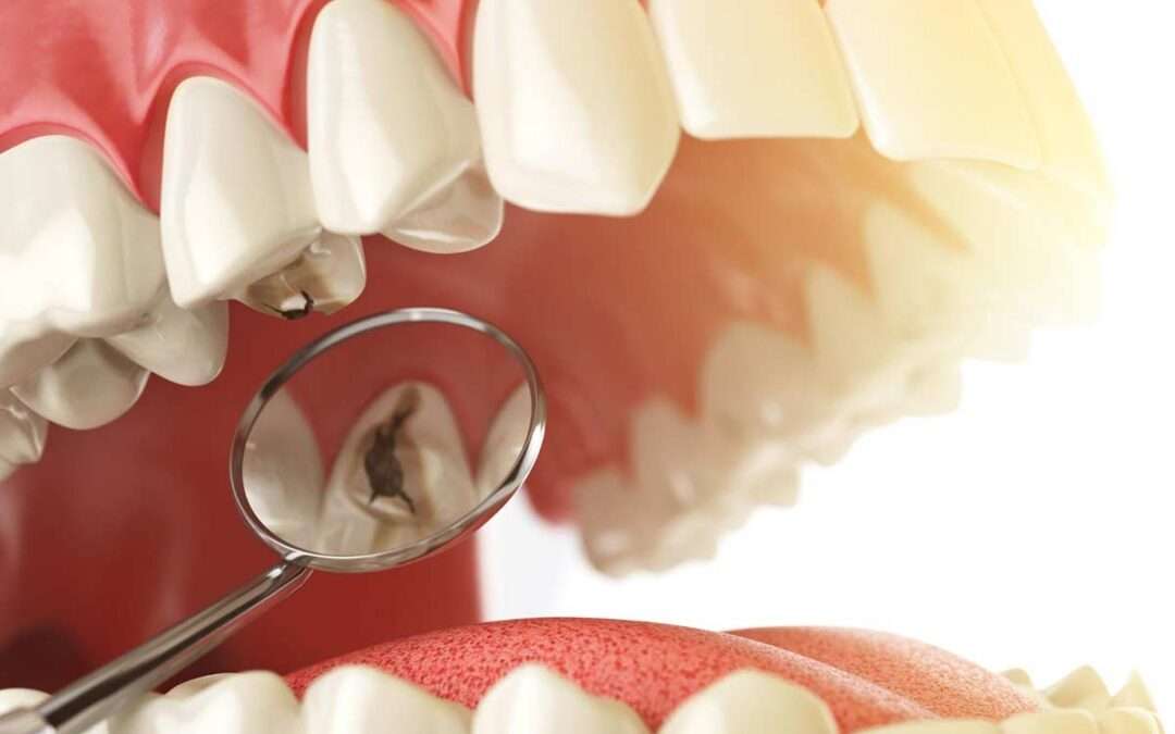 ¿Qué es una caries?