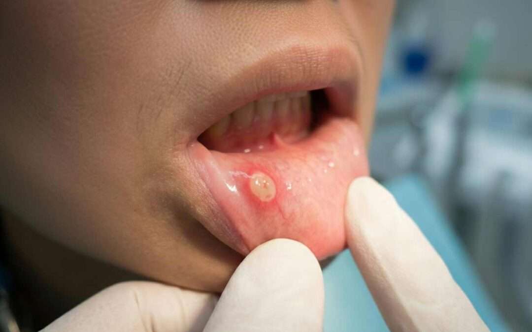 Aftas bucales: qué son, por qué aparecen y cómo aliviarlas