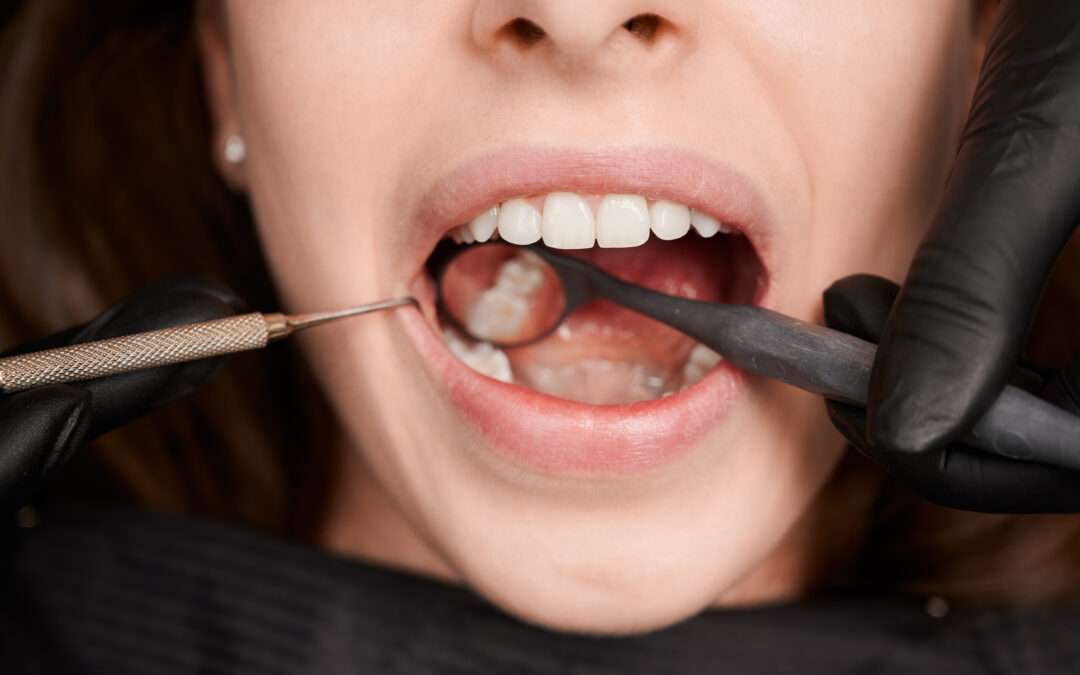 ¿Se te ha caído un empaste? Qué hacer y cuándo acudir a Adur