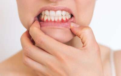 Gingivitis: por qué aparece y cómo tratarla antes de que vaya a más